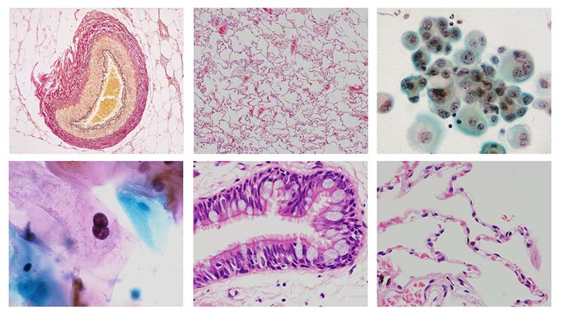 上段：左から①筋型動脈、EVG染色、病理組織標本②肺、H&E染色、病理組織標本③悪性胸膜中皮腫、胸水細胞診 下段：④軽度異形成、細胞診、子宮頸がん集団検診⑤肺気管支腺、H&E染色、病理組織標本⑥肺胞、H&E染色、 病理組織標本