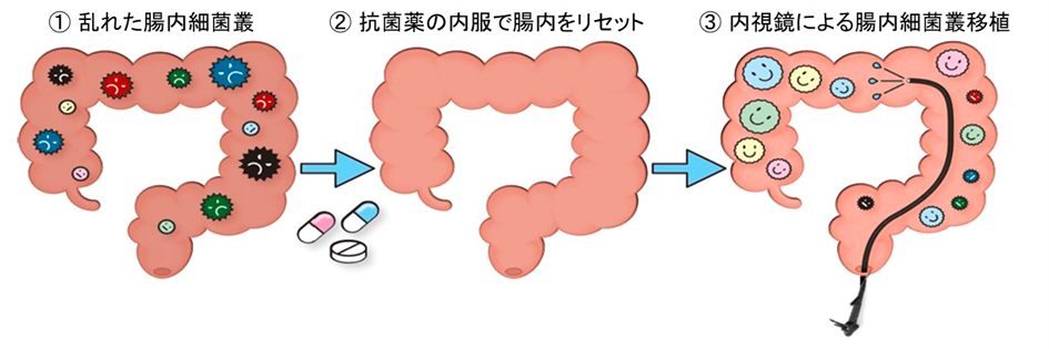 抗菌薬併用腸内細菌叢移植療法画像1