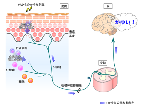 内臓 乾癬 原因