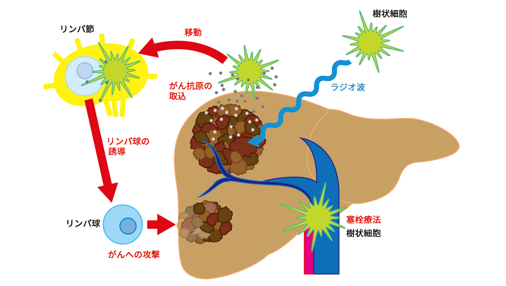 樹状細胞免疫療法臨床試験